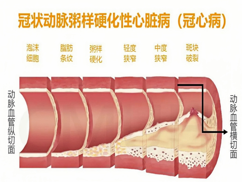 冠状动脉粥样硬化性心脏病严重吗