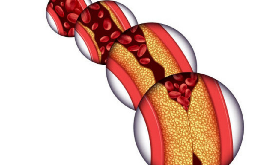 冠状动脉粥样硬化性心脏病能活多久